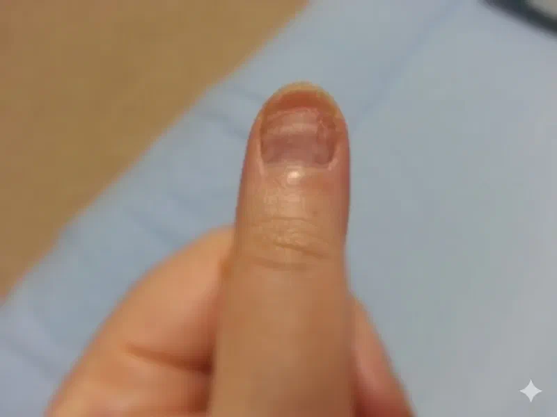 抗がん剤副作用で変色した爪。爪の下が真紫に変色し、表面には細かいスジが無数に入っている