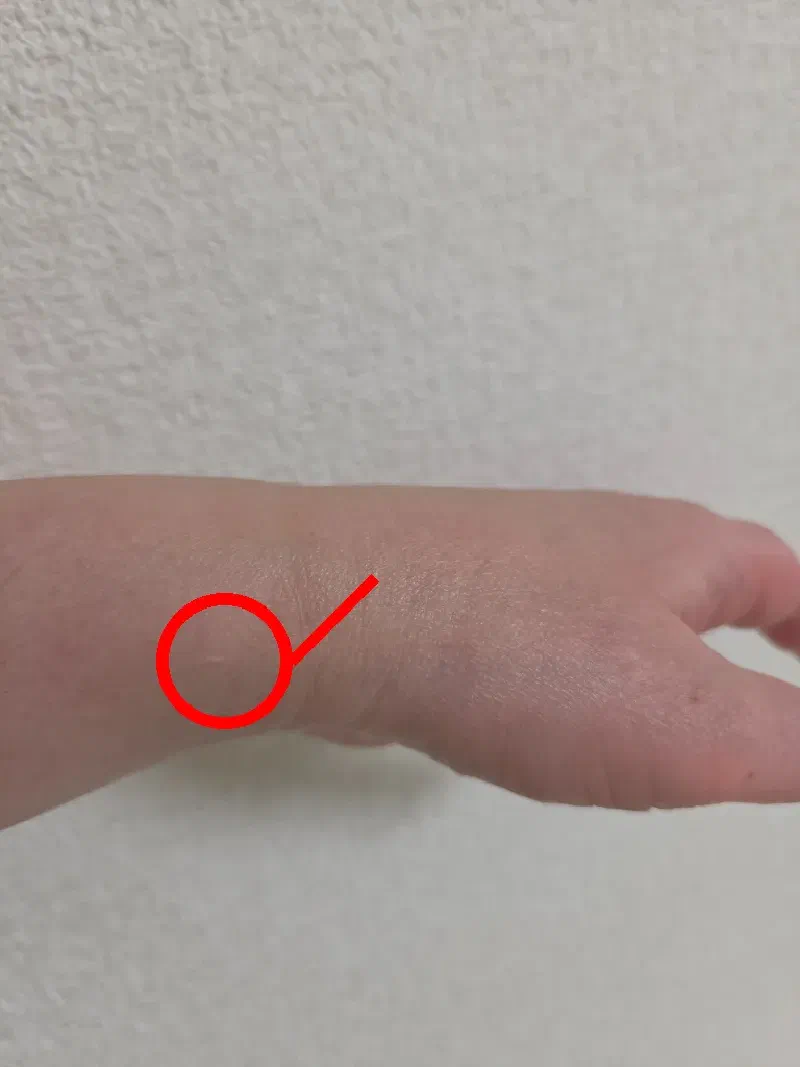 正解画像。赤丸で示した場所に、シワに紛れるほど小さな傷跡がある。