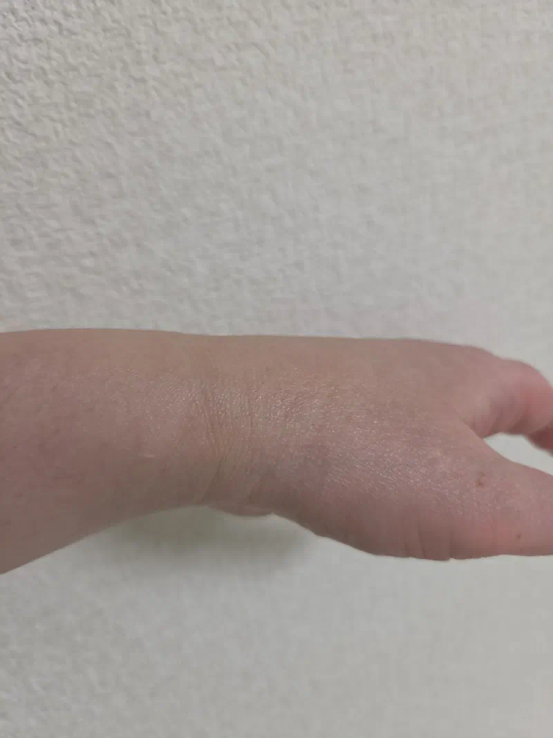 手術後の手首の写真。ほとんど傷跡がわからない状態。どこに傷があるか探してみてください。